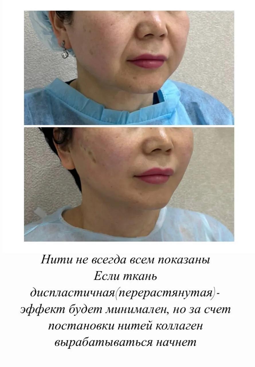 Услуги омоложения в Анталье