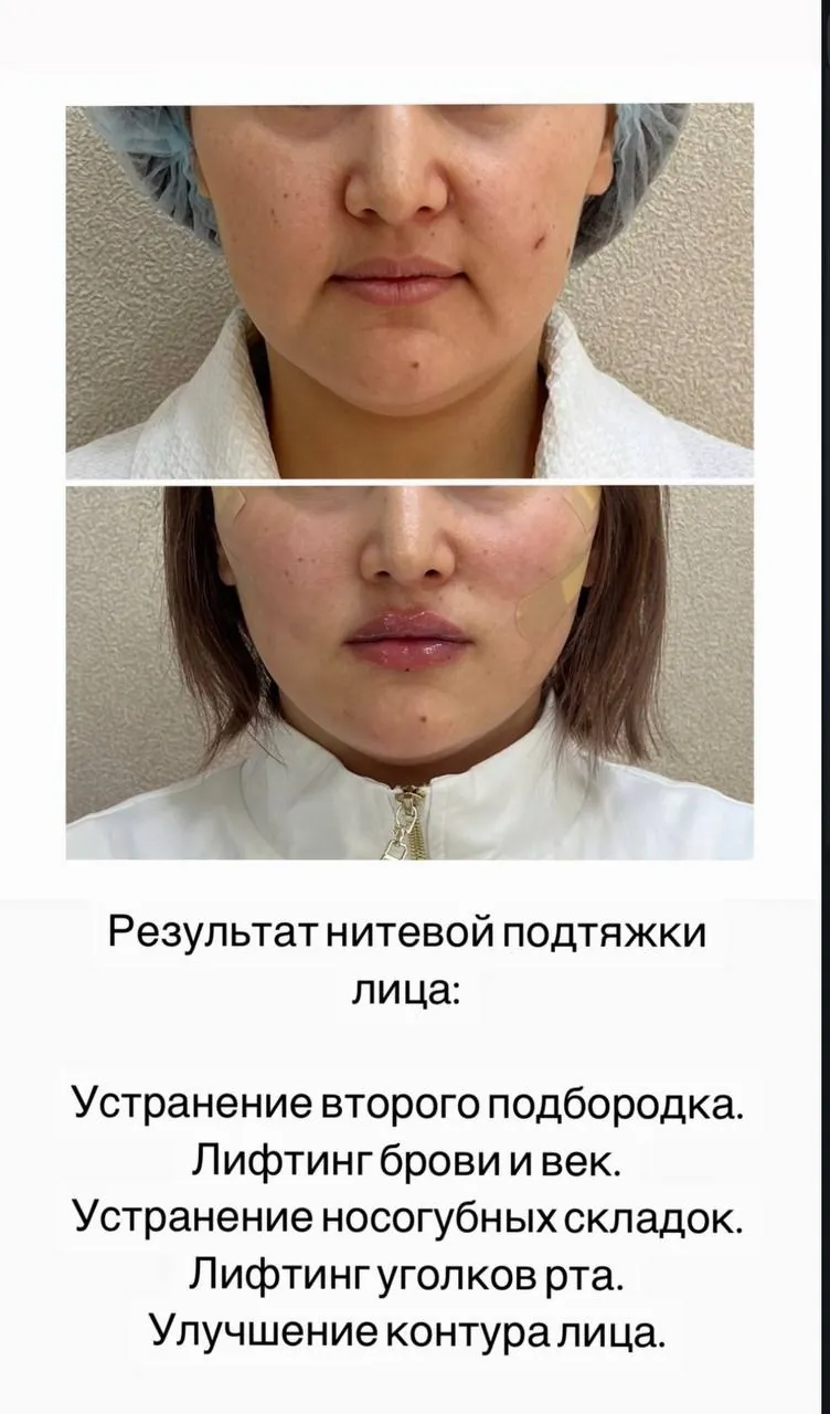 Услуги омоложения в Анталье 5