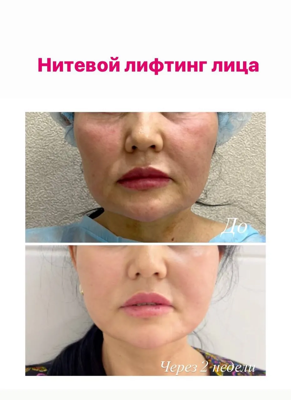 Услуги омоложения в Анталье 4